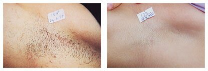 Berfore & After Hair Removal